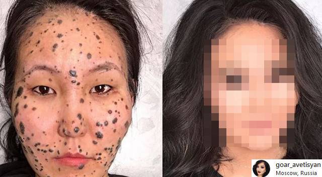 Ta dziewczyna miała całą twarz w ZNAMIONACH. Zobaczcie, CO jej pomogło!