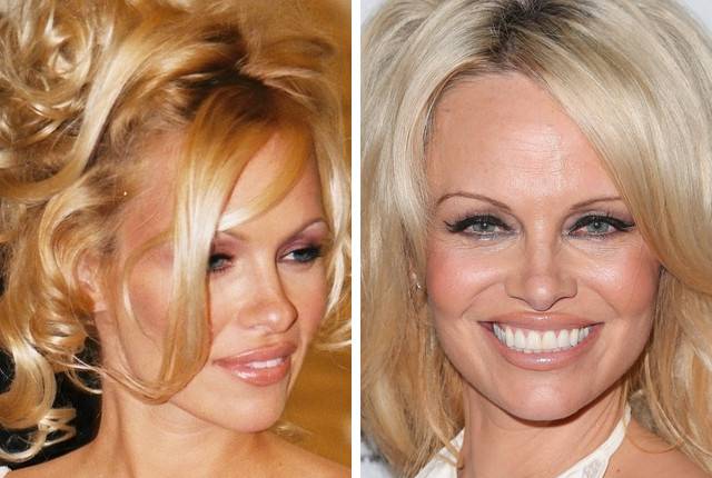 Najgorsze przypadki operacji plastycznych