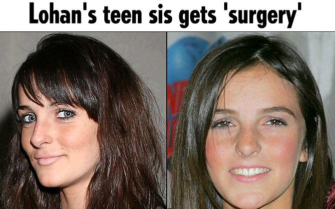 Ali Lohan przeszła operację plastyczną?