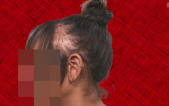 Ta gwiazdka przez lata nosiła doczepy, teraz płacze i pokazuje jak łysieje