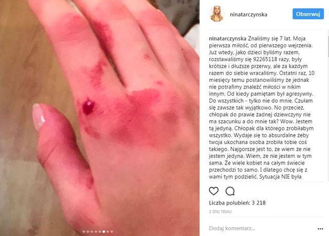 KOSZMAR! Polska modelka POBITA przez chłopaka (Instagram)