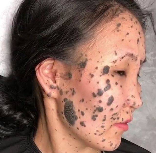 Ta dziewczyna miała całą twarz w ZNAMIONACH. Zobaczcie, CO jej pomogło!