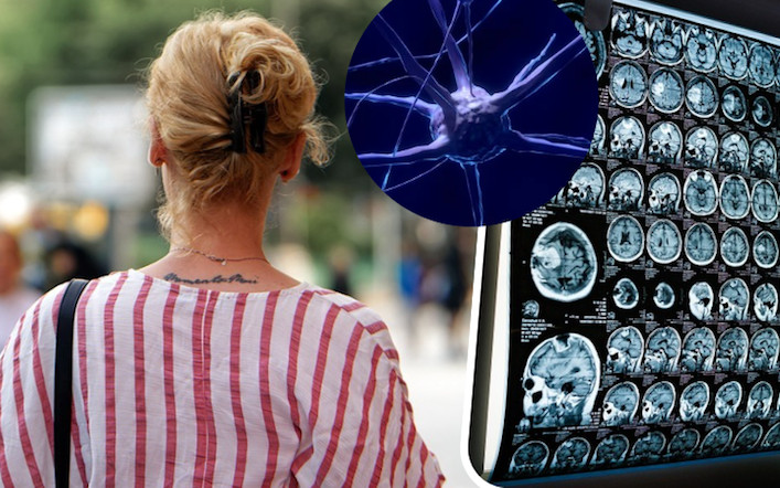 Ponad 90 TYSIĘCY udarów mózgu rocznie! Coraz częściej dotyka MŁODYCH ludzi