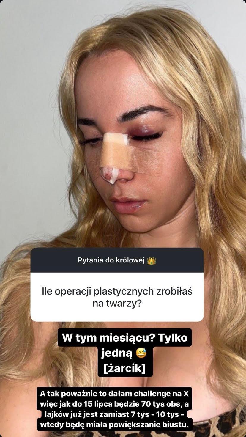 Operacja nosa u Marianny Schreiber