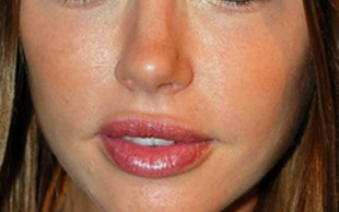 Napompowana Sophie Monk (FOTO)